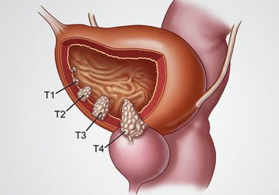 Mesane Kanserinde TUR Yöntemi