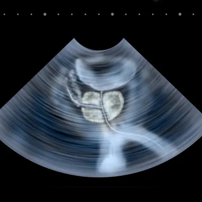 Prostatit Tedavisinde Üretral/Prostata Ozon Uygulamaları