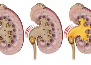 Üreter Taşı Tedavisi İçin Şok Dalga Tedavisi (ESWL)