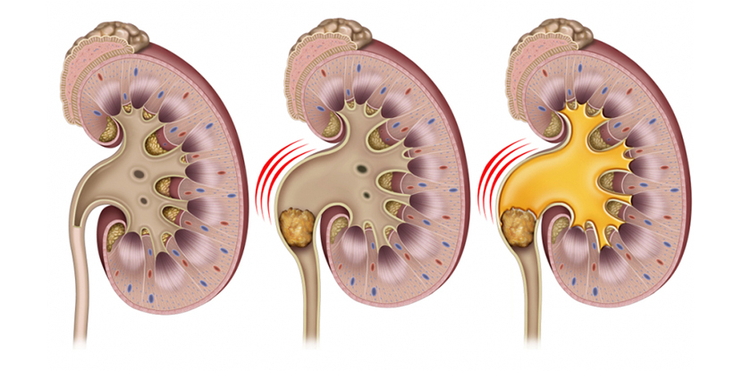 Üreter Taşı Tedavisi İçin Şok Dalga Tedavisi (ESWL)
