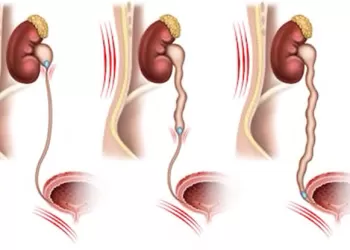 Üreter Taşı Tedavisi – Fleksible URS ameliyatı