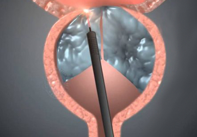 Holmium Lazer Prostat Ameliyatı (HoLep) Nasıl Yapılır? Thulium Lazer Prostat Ameliyatı (ThuLep)'ndan farkı Nedir?