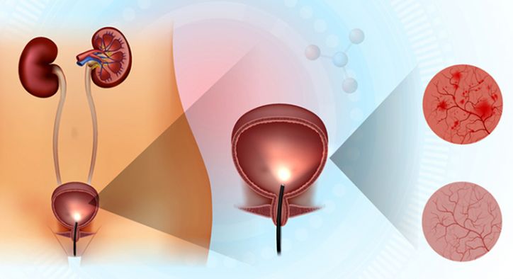 İnterstisyel Sistit İntravezikal Tedavisi