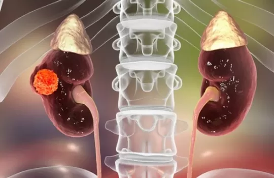 Tromboz Böbrek Kanseri