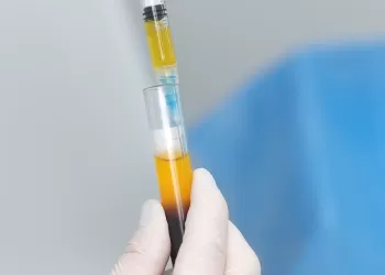 Trombositten Zengin Plazma (PRP) ile Yenilikçi Rejeneratif Tedavi ve Ağrı Hafifletme Yöntemleri