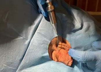 Erken Boşalma Tedavisinde Selektif Dorsal Kriyoablasyon Tedavisi