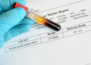 Prostat Büyümesi PSA’yı Yükseltir mi?